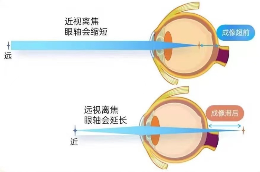 控制近視增長的方法